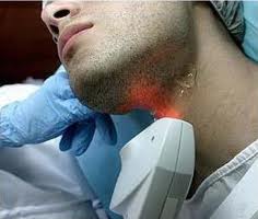 laser, la depilacion definitiva